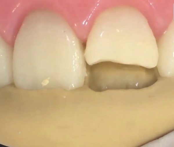 Những cách chữa trị cho răng bị vỡ mẻ